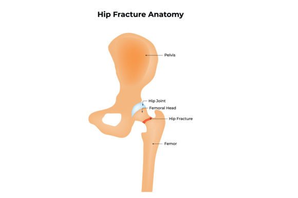 Download Hip Fracture Anatomy Science Design - Hip Collection